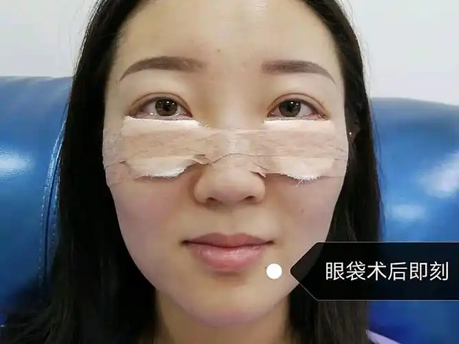 【外切去眼袋术后第0天】