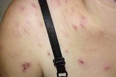 神经性皮炎和湿疹有什么形态上的区别?