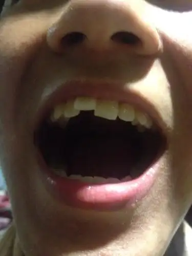 大门牙一颗突了出来,是旁边一个牙齿卡到了所以突了出来,拿去矫正要