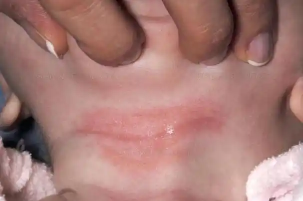 男宝宝阴囊褶皱处发红