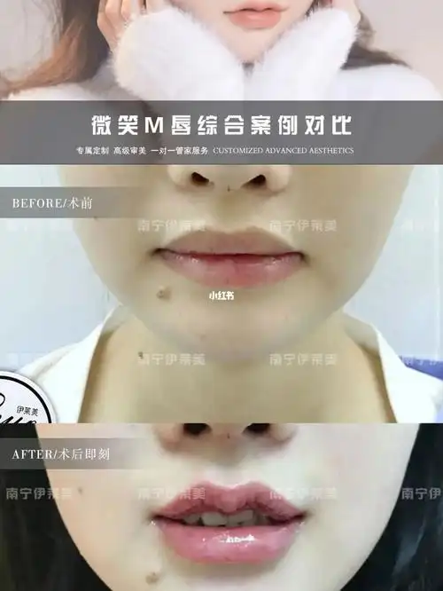微笑m唇综合对比