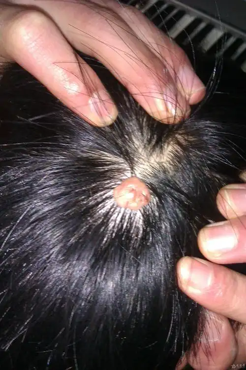 [皮肤病] 这是什么?如何治疗?