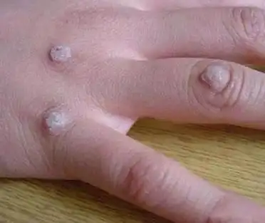 瘊子怎么治疗不会再传染(瘊子会自己消失不用治)(1)