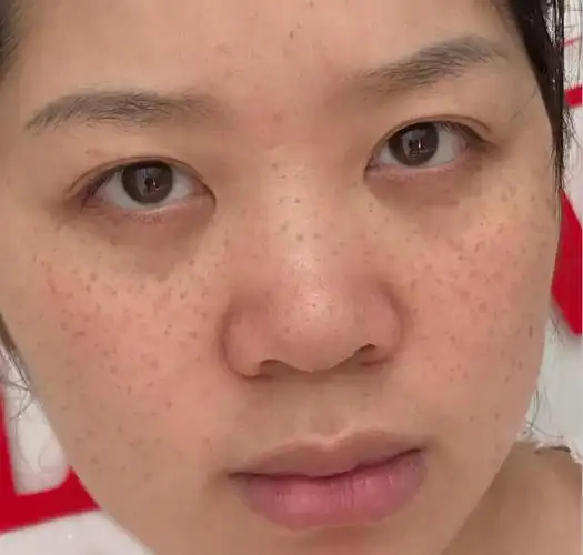 亲身经历,祛黄褐斑的励志故事