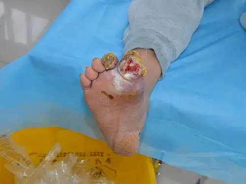 糖尿病脚趾头腐烂症状应该怎么治疗