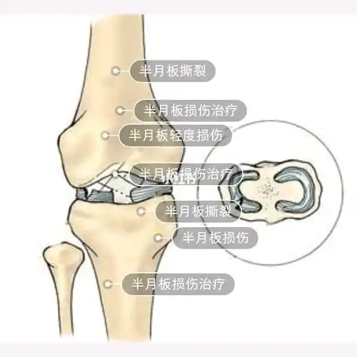 半月板损伤症状表现