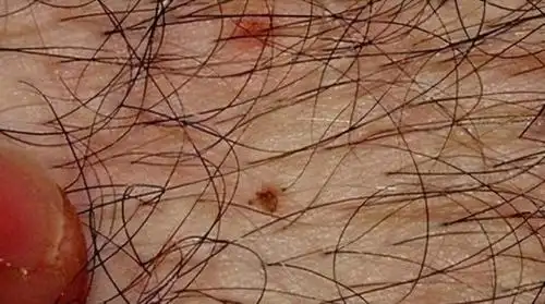 为什么现在很多人得了阴虱到底是什么两种传播途径是主要原因