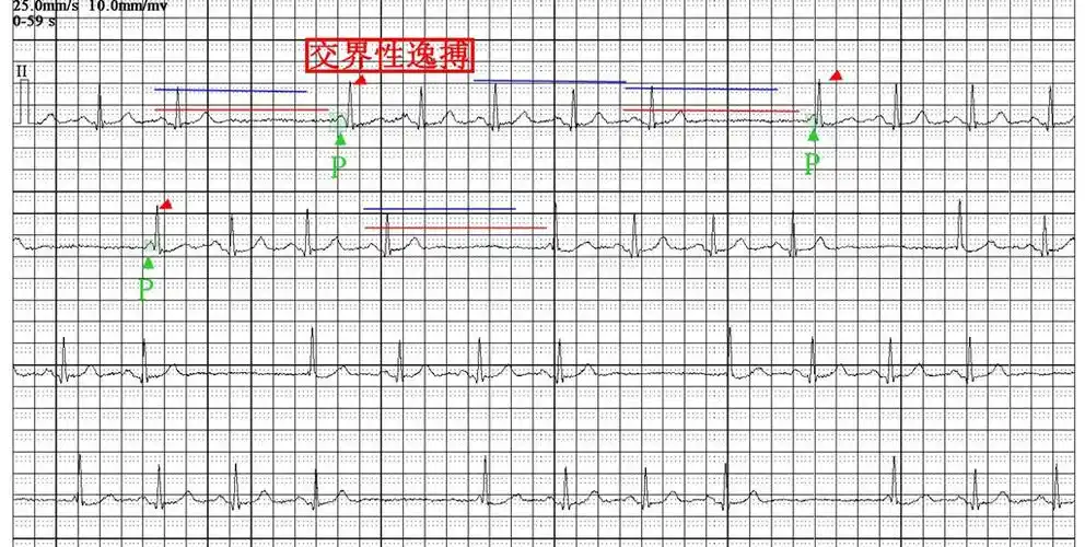 心电图图例分析:窦性停搏,交界性逸搏伴干扰性房室.
