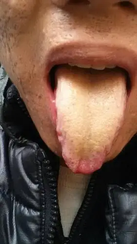 有和我一样舌尖烂看好的吗,看了好多医生,吃了好