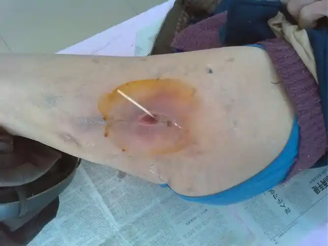 难愈的结核窦道有图片求教