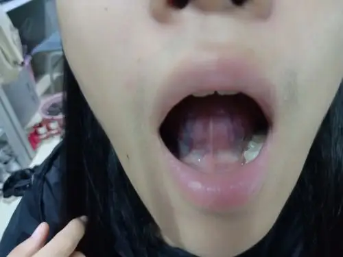 舌下络脉偏紫色