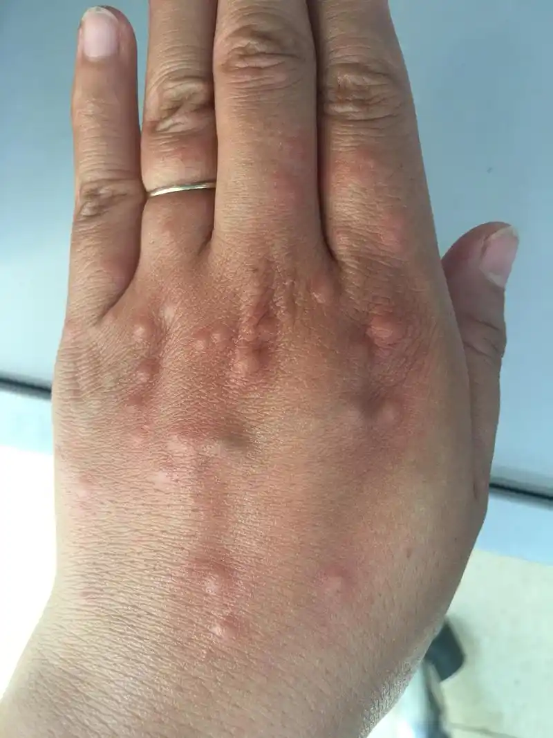 吃螃蟹禁忌贪多,湿气重,奇痒,这就是代价!