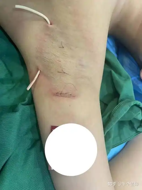 腋臭微创手术恢复