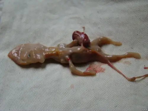 引产出类似干尸样死胎