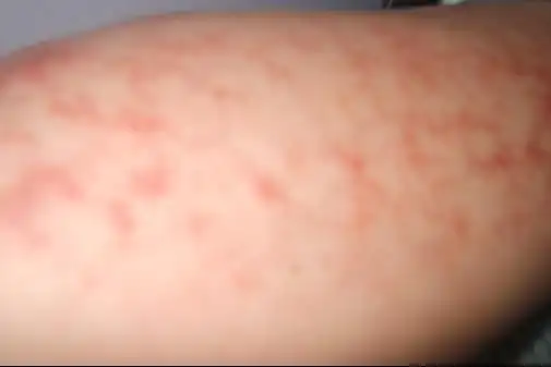 长时间烤取暖器导致右腿外侧一大片红斑还有网状血丝样的,怎么办啊