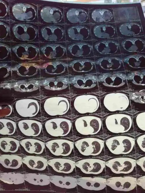 弟浸润性晚期肺腺癌