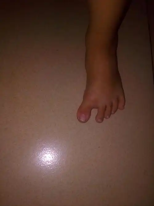 2岁宝宝走路的时候脚大拇指分很开,有些畸形,但是不走路的时候一切