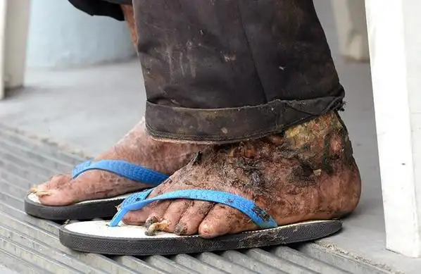 疑糖尿病导致脚腐烂,独居老汉左脚爬满蛆虫发出恶臭,却担心截肢拒绝