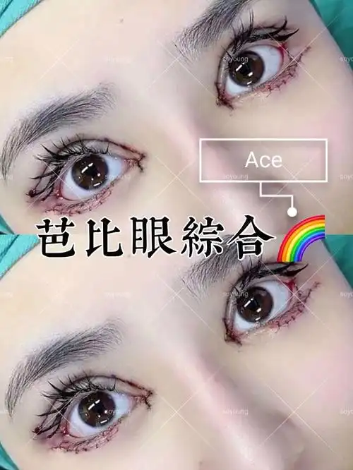 欧式芭比眼部多项98全方位放大双眼,四项全开,下至与外_圈子-新氧