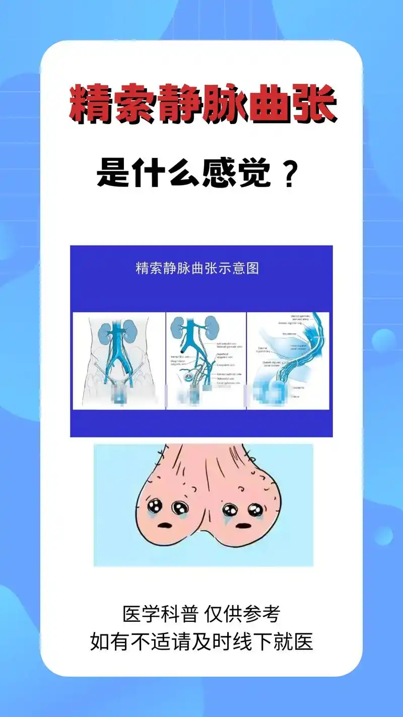 精索静脉曲张.#男科小知识 #男科 #科普一下 - 抖音
