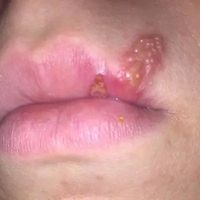 嘴唇白点艾滋病图片 (34)