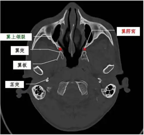 下:翼腭管---腭大,小孔---口腔外:翼上颌裂---颞下窝内:蝶腭孔---鼻腔