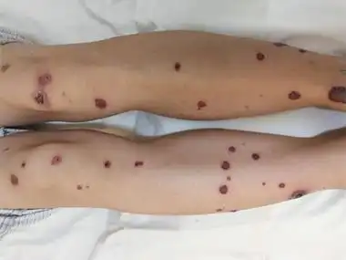 变应性皮肤血管炎小腿上斑丘疹结痂图