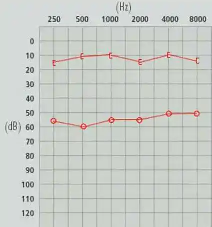 传导性耳聋:骨导曲线正常或接近正常,气导曲线听力损失在30～60db之间