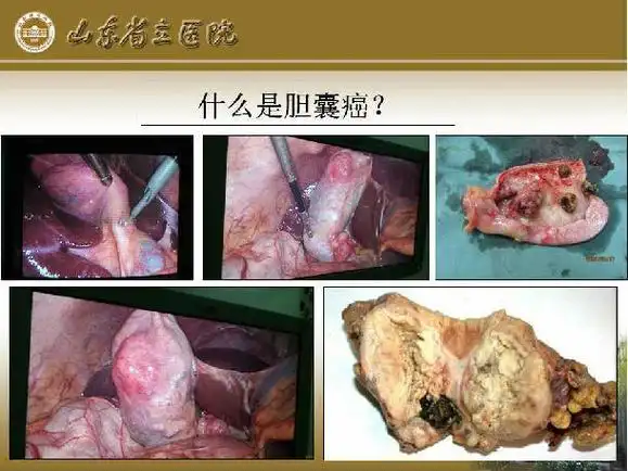 胆囊癌手术须知 - 好大夫在线