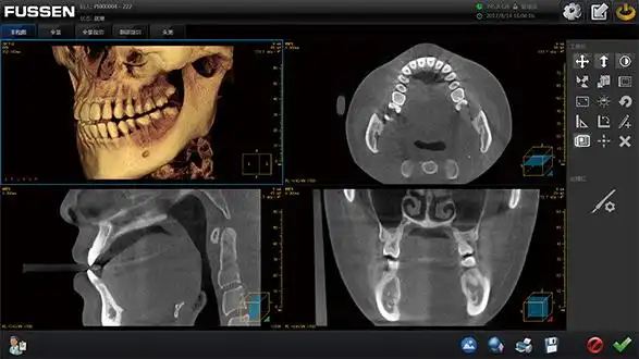 口腔ct3合1品牌_三维数字化口腔ct机价格-菲森影像