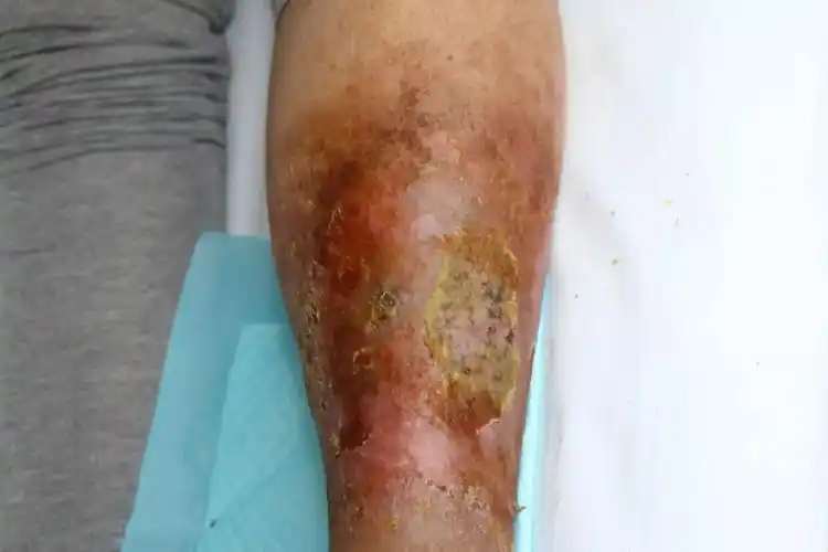 感染严重,耄耋老人小腿溃烂不能行走——遇到他们……十天后老人走路