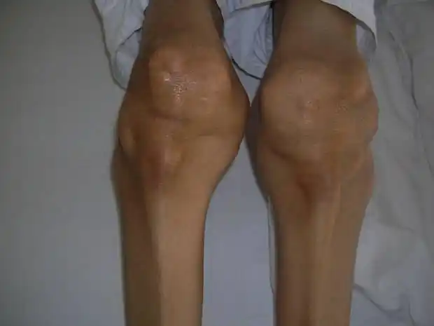 膝关节痛风的症状,治疗方法和日常生活保养