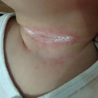 医生说是湿疹,可是涂了湿疹膏也没有用