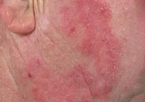 脸上长癣图片早期症状皮肤发红.脸上长癣图片脸颊大斑块.
