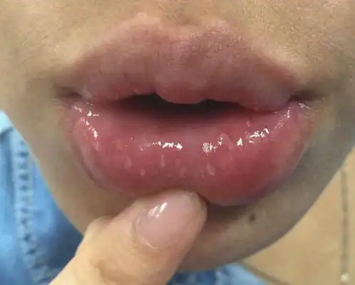 疱疹介绍_疱疹病因_疱疹治疗_疱疹医院医生_有来医生