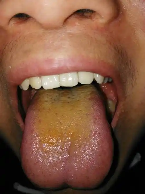 舌苔黄成这样了 什么情况啊 咳嗽快一星期了 班上每天都要开空调 好