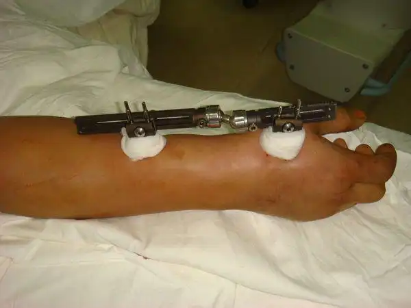 腕部骨折 外固定架固定 康复指南