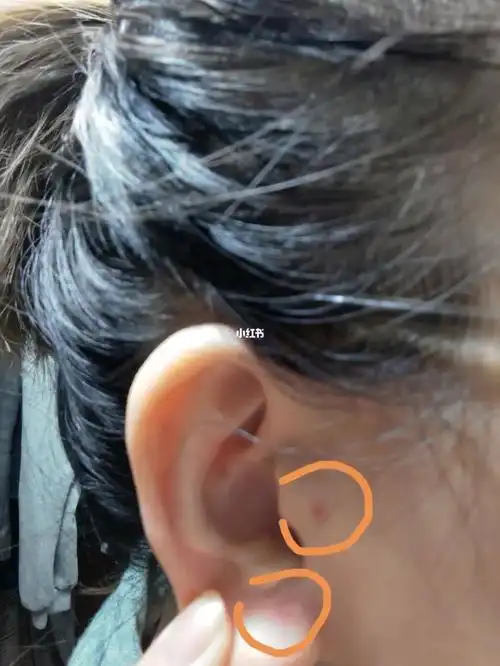 耳朵居然长痘痘了