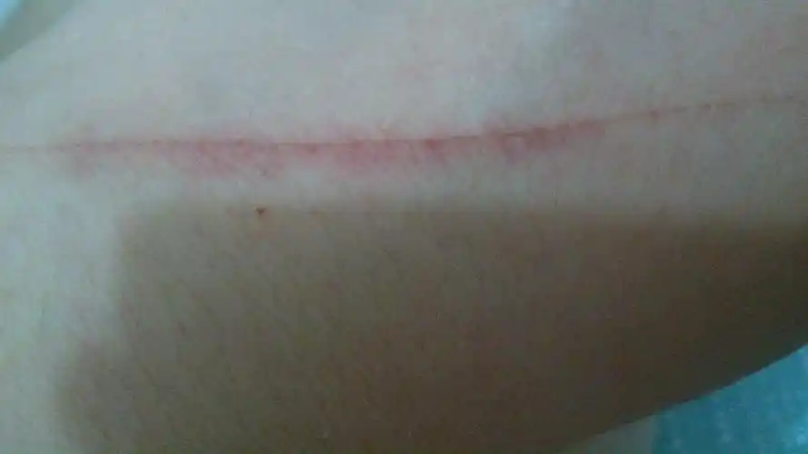 问:手被划伤 会留疤吗