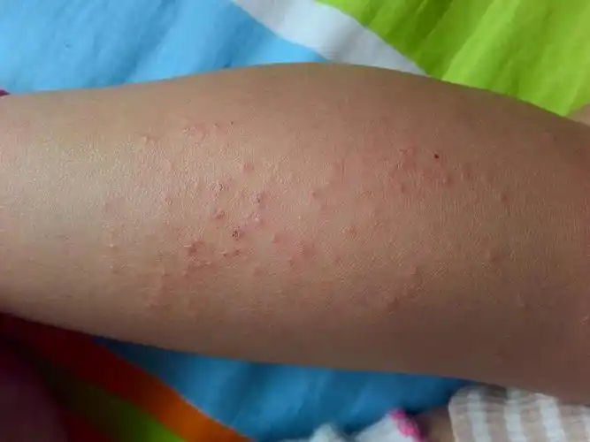 2岁的宝宝腿上,胳膊上起了好多疹子,不知道是什么?