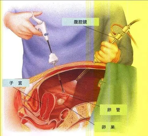 做了结扎,后悔还来得及吗?收好这个怀孕"姿势",男女都要知道~_输卵管