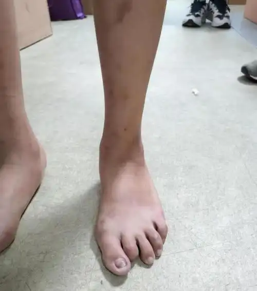 宝宝跑步外八字怎么矫正(两岁宝宝跑步内八字)--亚圣国学网