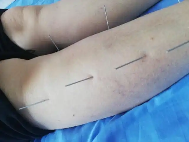 我见证针灸治脑梗腰脱失眠病的神奇不理解为何有人不信