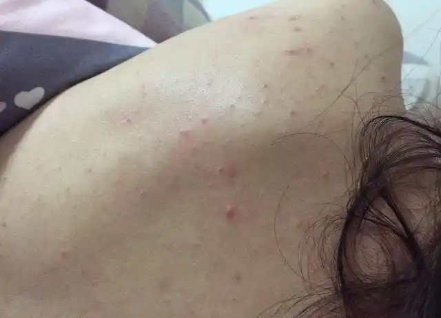 背上长满了螨虫痘痘,坚持这3件事,痘痘会越来越少,点击领走