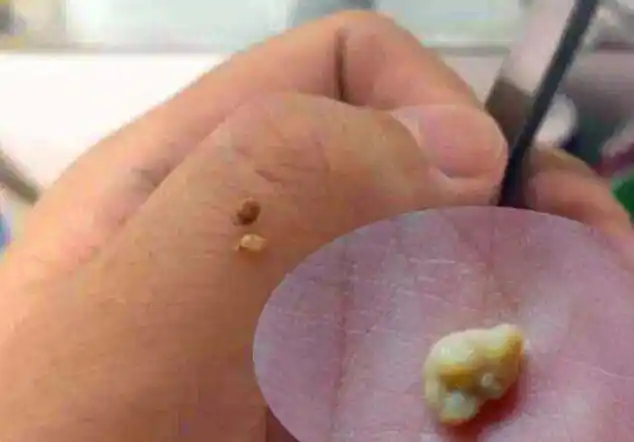 儿子被同学嫌弃嘴太臭,牙医取出的颗粒,宝妈闻了都直皱眉