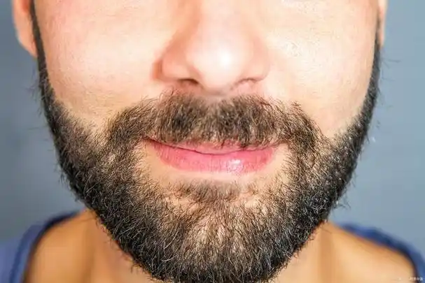 络腮胡子怎么去除