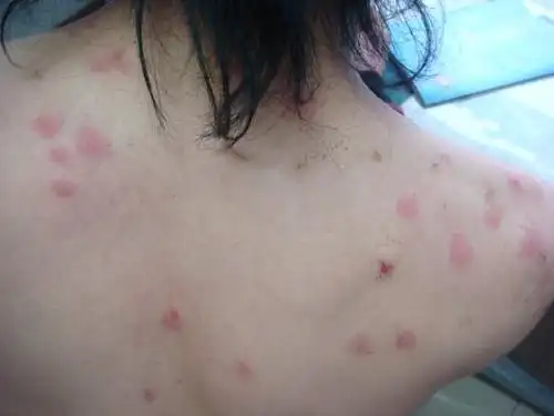 【螨虫叮咬后的症状图】螨虫性皮炎的成因及预防