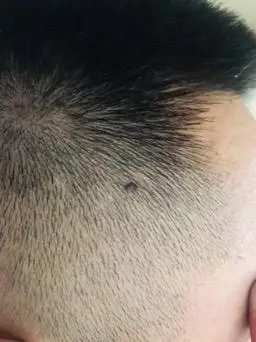老公身上本来就多痣,前几天推头,发现头上有个痣,颜色不均匀,也许