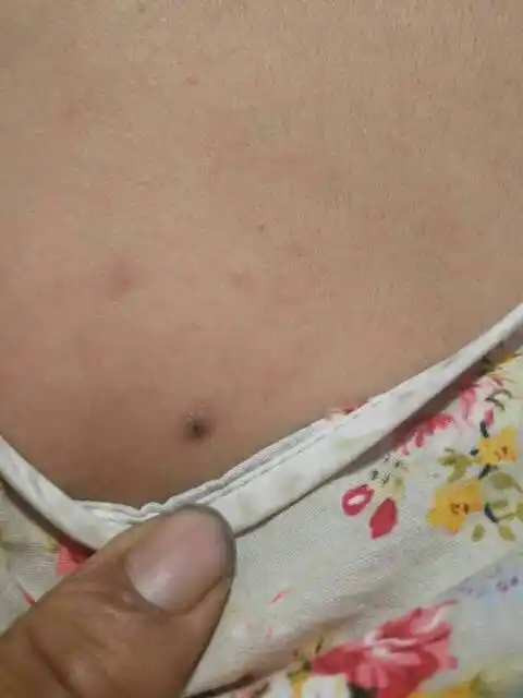 帮看看,后背长了一个黑色的东西,好像是在毛孔里出来的,挤不出来.