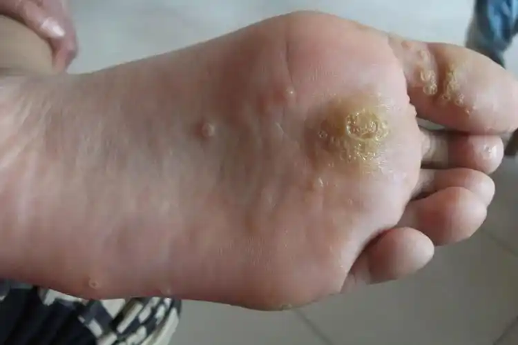 脚部跖疣,鸡眼,老茧,都是怎么回事?误判误治很麻烦!-图1